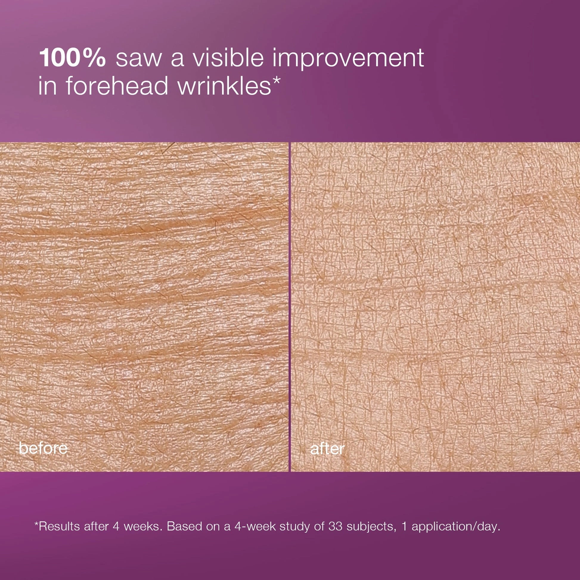 Dermalogica MultiVitamin Power Recovery Cream 50ml voor en na huidverbetering, zichtbaar resultaat bij voorhoofdsrimpels.