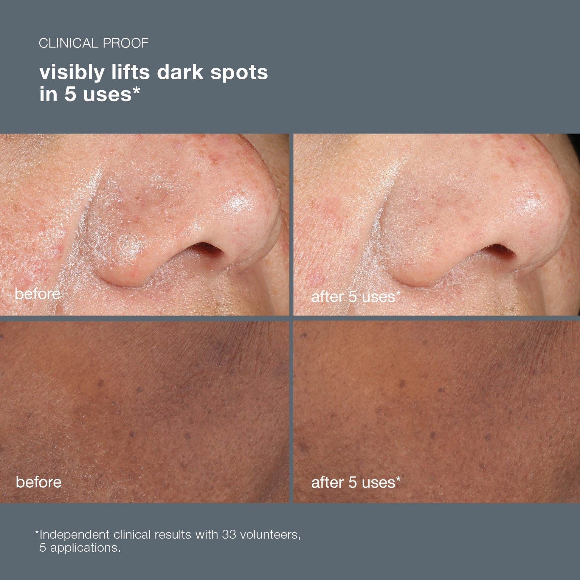 Dermalogica PowerBright Dark Spot Peel 50ml voor zichtbare vermindering van pigmentvlekken na 5 toepassingen.