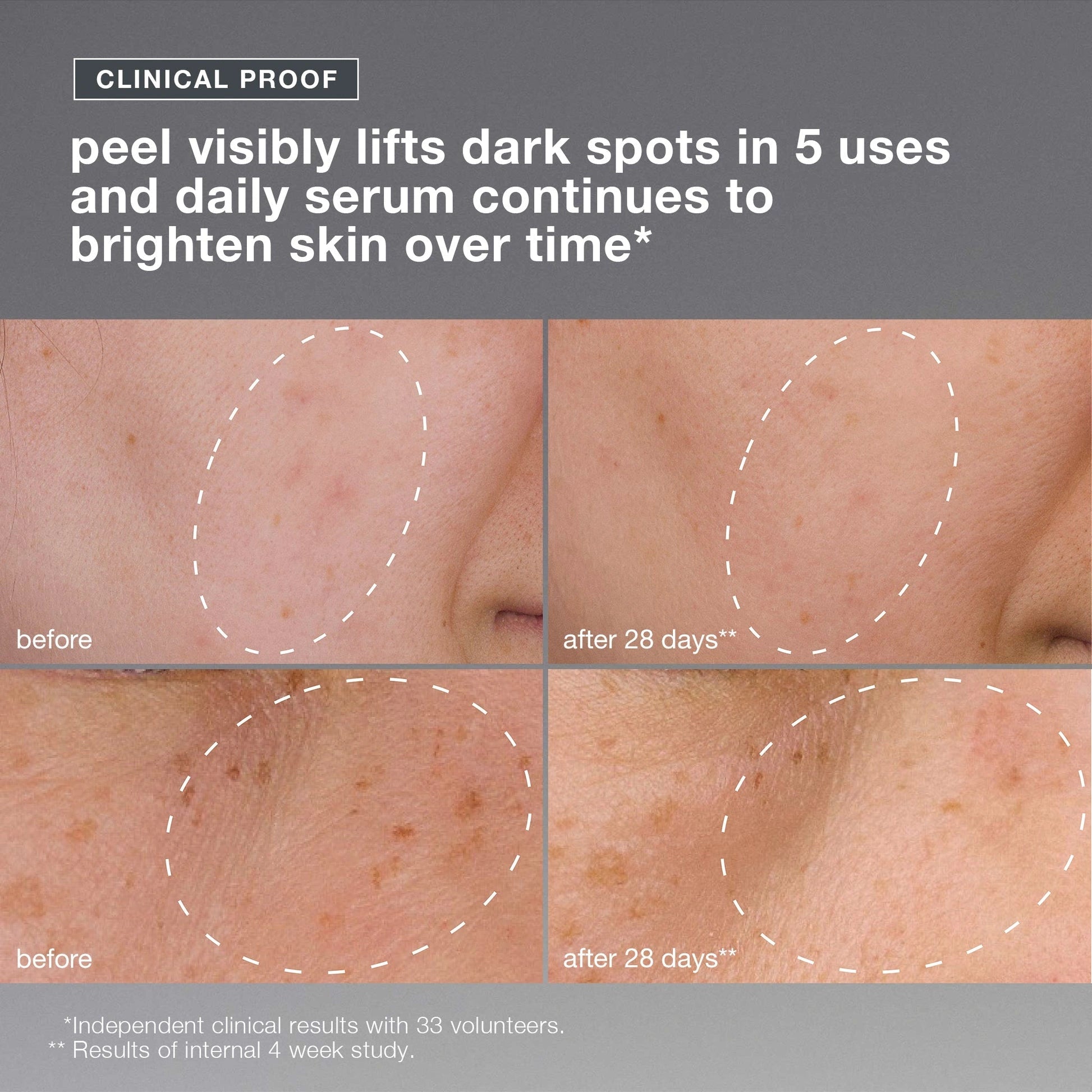 Dermalogica PowerBright Dark Spot System 80ml resultaten voor en na gebruik met zichtbaar vervaagde pigmentvlekken