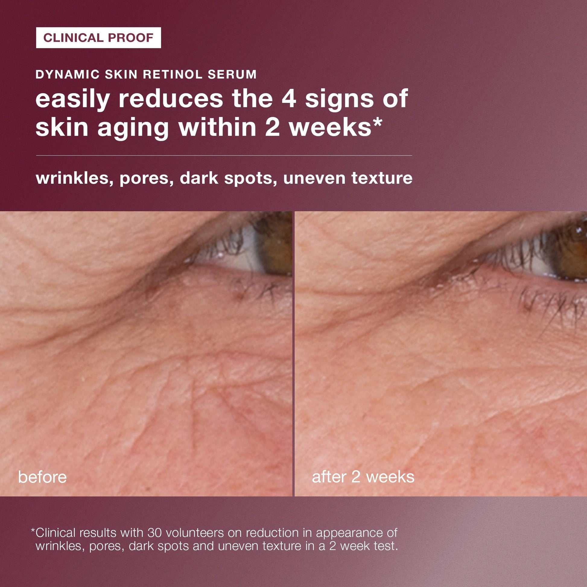 Dermalogica Skin Aging Solutions Kit resultaat voor en na gebruik, vermindert effectief rimpels en oneffen textuur.