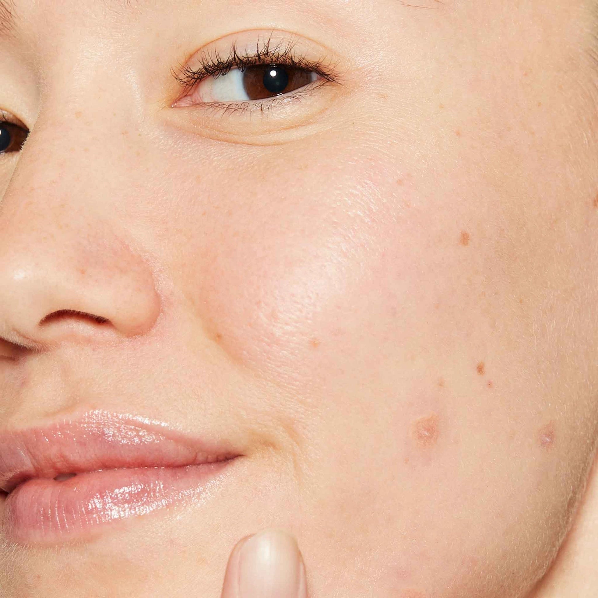 Dermalogica Deep Breakout Liquid Patch 15ml op huid met diepe puistjes, huidverzorging tegen onderhuidse onzuiverheden.